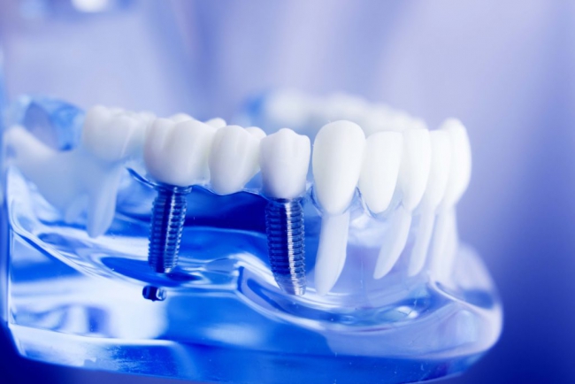 Виды протезирования зубов, какой зубной протез выбрать?